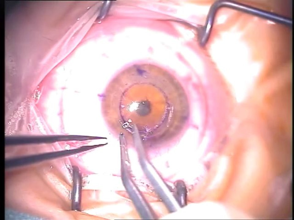 INTACS SURGERY FOR KERATOCONUS- DR IRFAN KUNDI