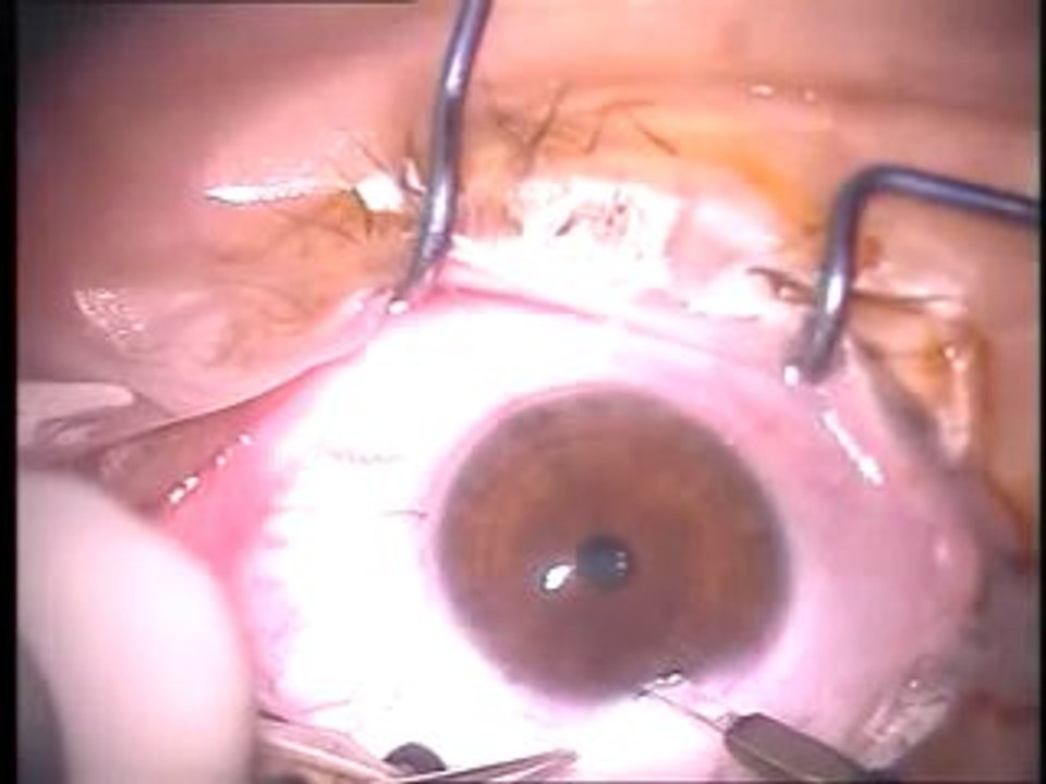 Artiflex  Phakic IOL to treat high Myopia - DR IRFAN KUNDI