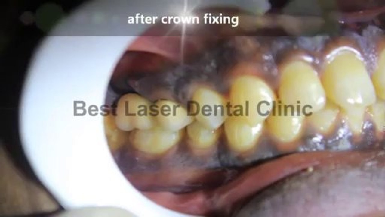 dental implants without sinus lift in india