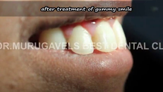 Gummy smile correction by lip repositioning surgery with laser -INDIA