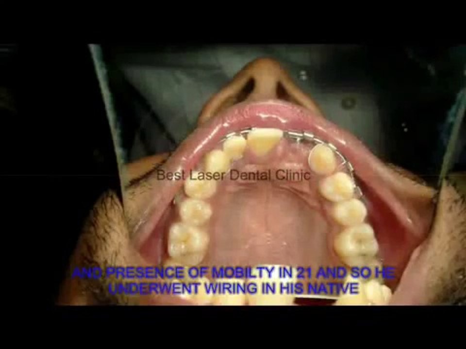 How to replace accidentally broken teeth with dental implants BCS