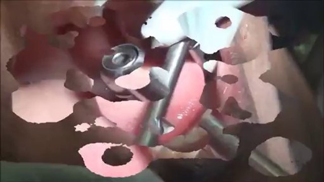 replacement of missing teeth by kos dental implants live procedure video