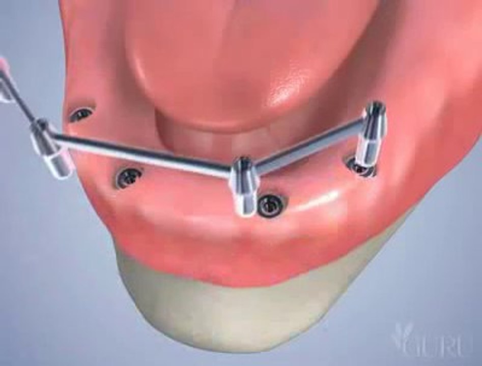 Pose de 4 implants dentaires avec une barre d'attachement