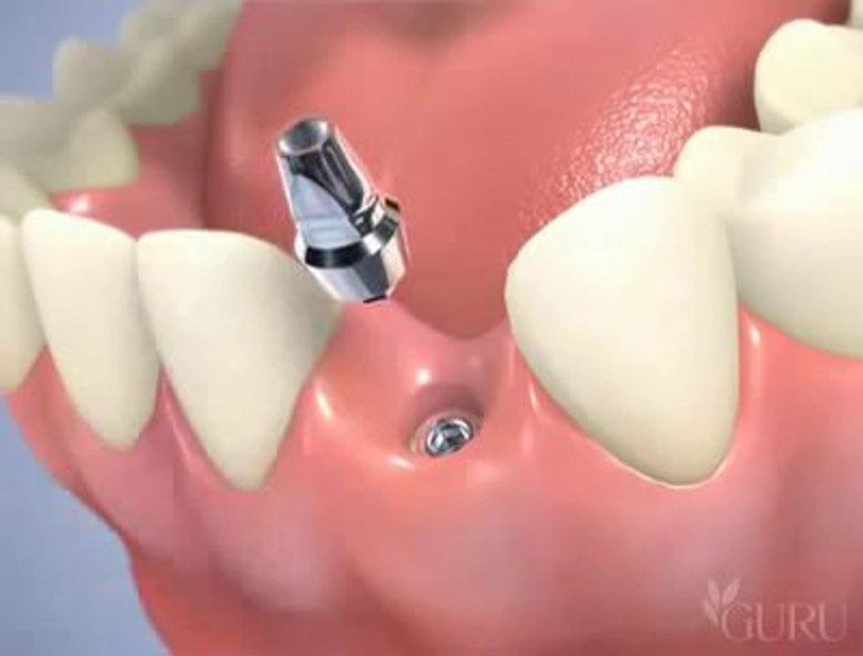 Pose d'un implant dentaire en 2 temps avec un pilier titane