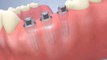Greffe osseuse avant la pose d'implants dentaires