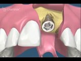 video-implant-dentaire-regeneration-osseuse-guidee