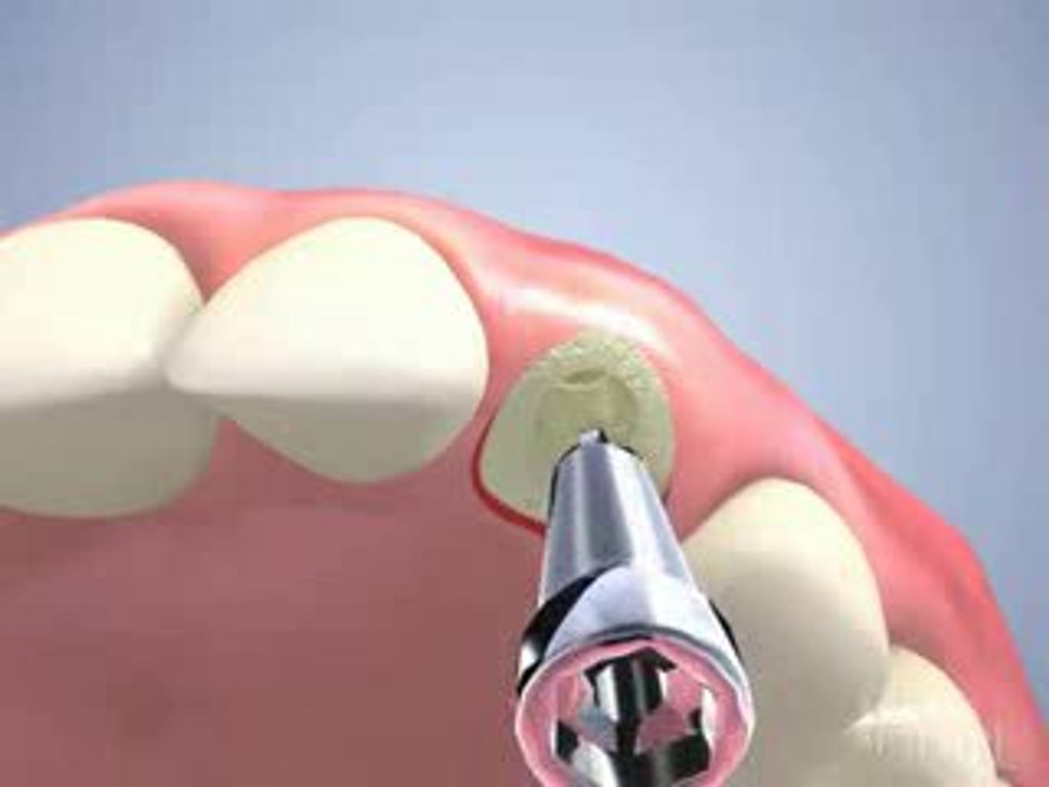 Pose d'implant dentaire