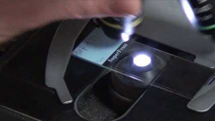 Le diagnostic rapide du cancer du sein