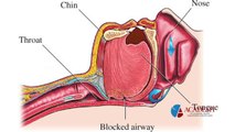 What is Sleep Apnea, With Dr. Roger Biede, Dentist in Tucson, Arizona