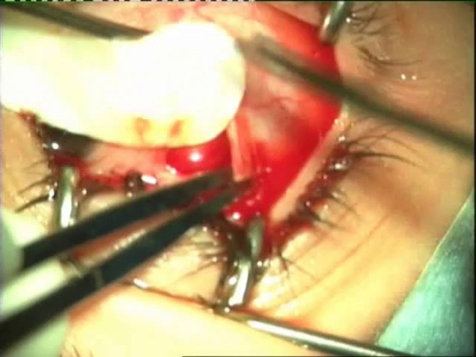 Scleroplasty - by Dr Irfan Kundi