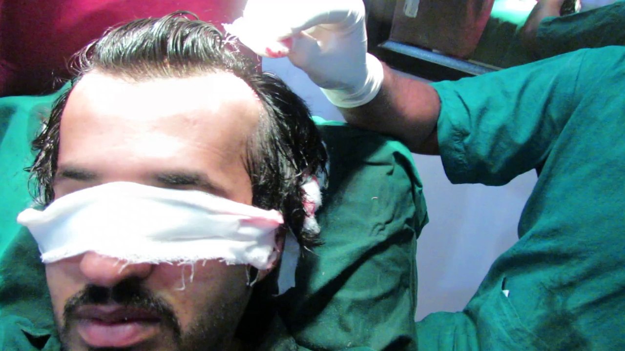 Hair Implants in Banglaore