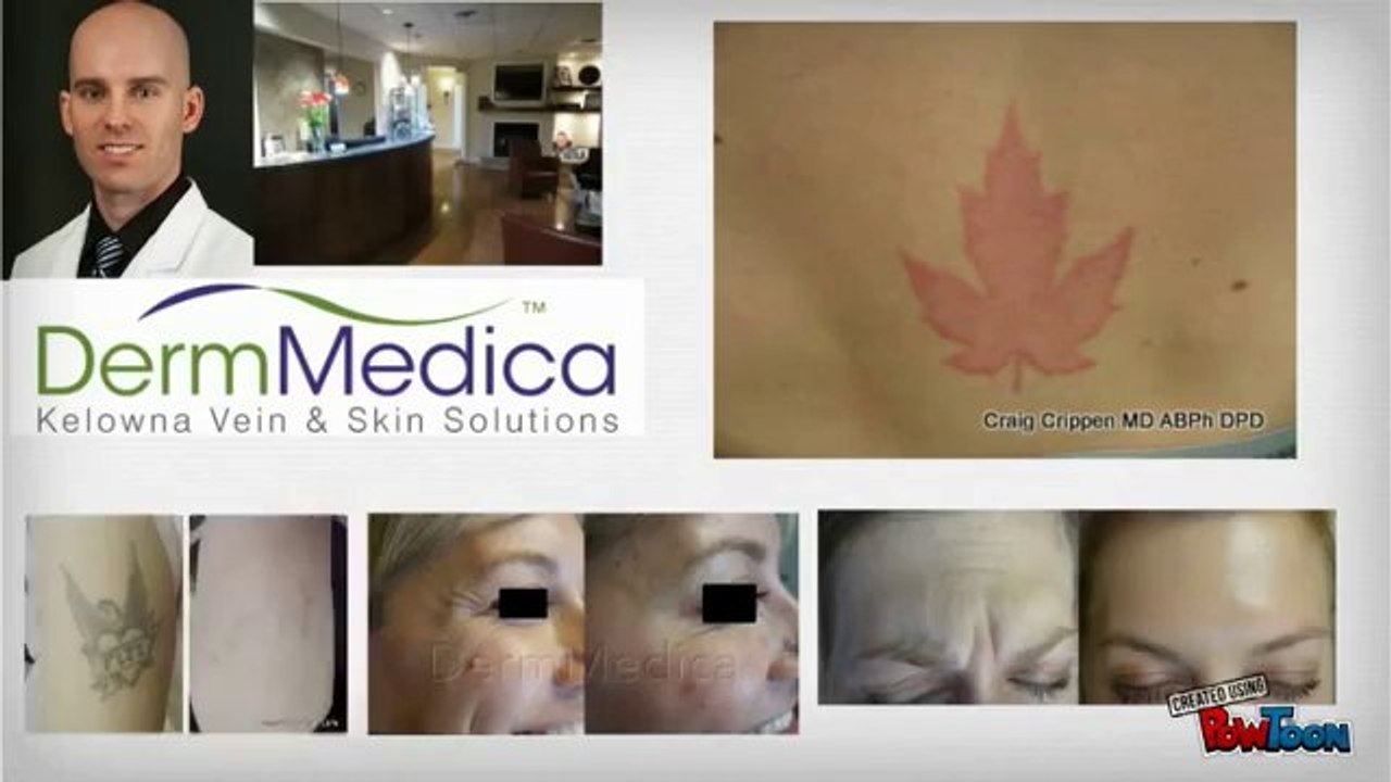 botox kelowna