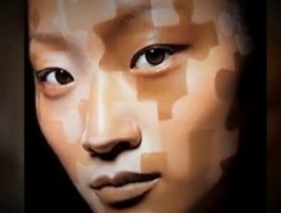 the Natural Vitiligo Treatment System