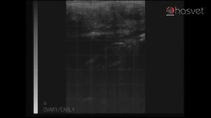 BCF Ultrason Görüntüsü - Hasvet Medikal