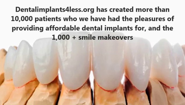 Affordable Dental Implants Miami