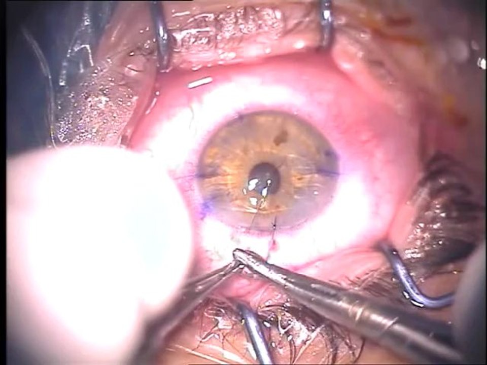 Toric Phakic IOL - Surgery by Dr Irfan Kundi
