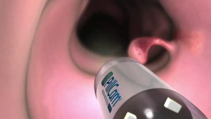 Una cámara-píldora que pretende acabar con las colonoscopias