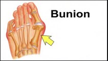Bunions - Podiatrist Arnold Hertz in Woodmere, Cedarhurst,Hewlett, NY