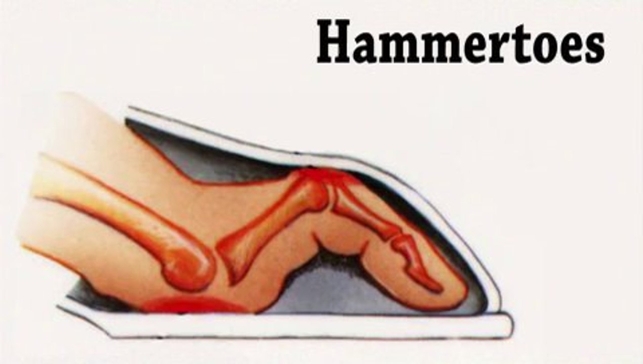 Hammertoes and Corns - Podiatrist Arnold Hertz in Woodmere, Cedarhurst,  Hewlett, NY