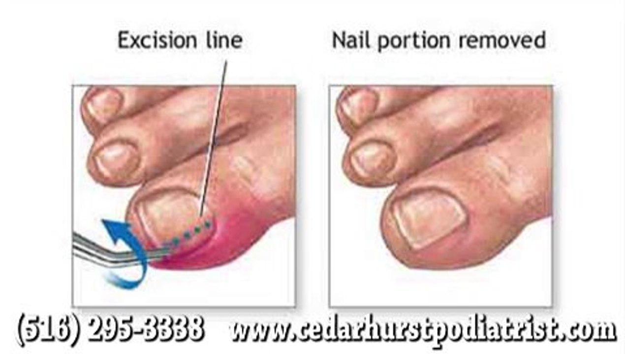 Ingrown Toenail - Podiatrist Arnold Hertz in Cedarhurst, Woodmere and Hewlett, NY