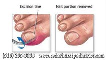 Ingrown Toenail - Podiatrist Arnold Hertz in Cedarhurst, Woodmere and Hewlett, NY