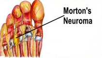 Morton’s Neuroma - Podiatrist Arnold Hertz in Cedarhurst, Woodmere and Hewlett, NY