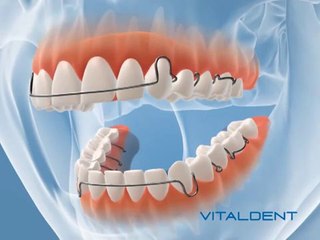 Clínica Vitaldent Ceuta: Ortodoncia infantil