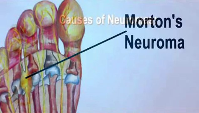 Morton’s Neuroma - Podiatrist in Prattville, Montgomery. Alabama - Michael Rosenberg, DPM