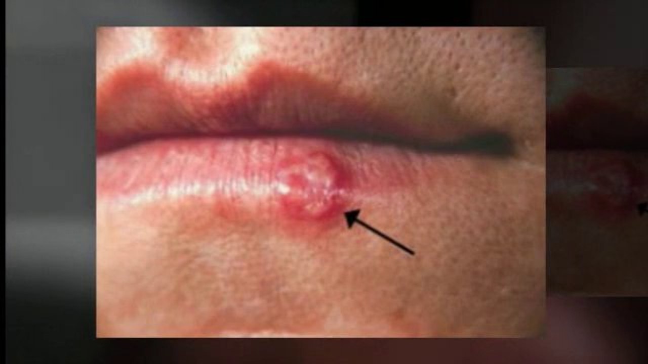 Cure For Herpes