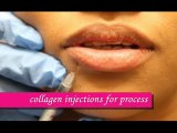 Lip Enhancement brighton