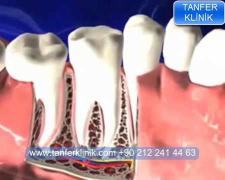 Tanfer Klinik - Çene kistleri tedavi edilmezse ne olur