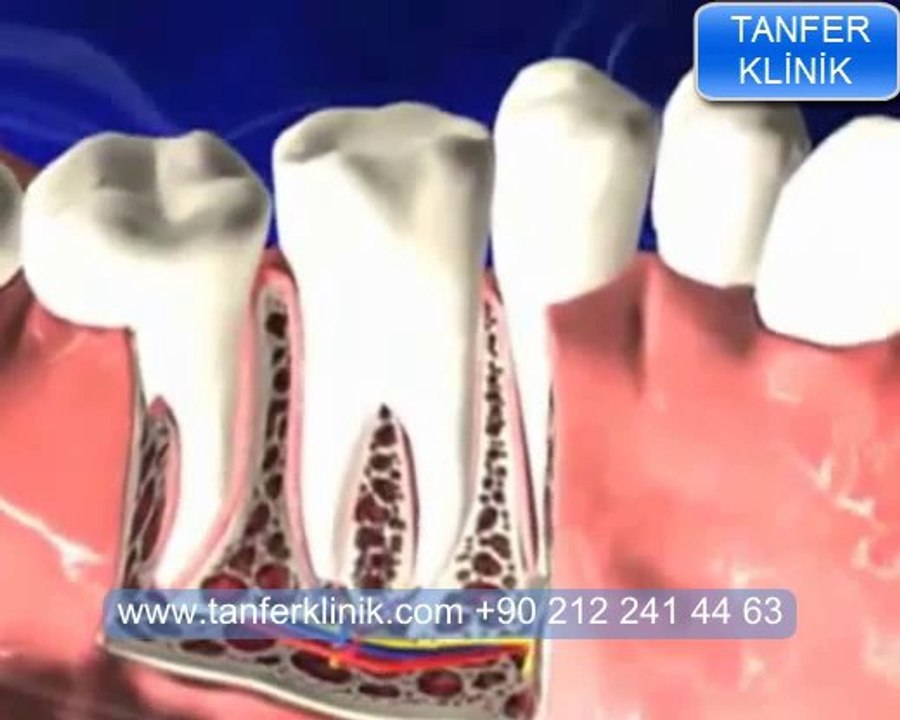 Tanfer Klinik -  Çene kistleri tedavi edilmezse ne olur