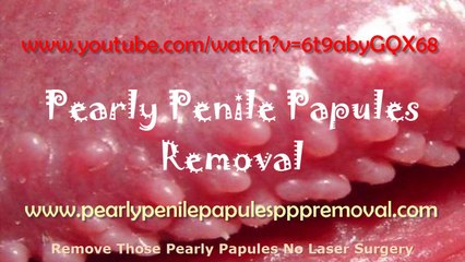 Can Pearly Penile Papules Be Transmitted