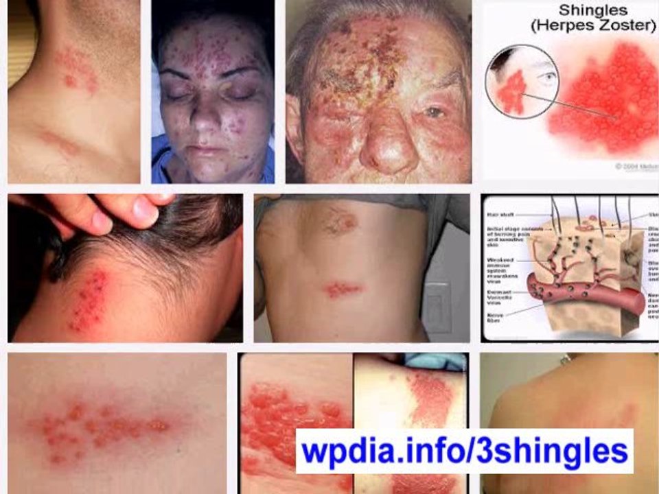 SHINGLES (herpes zoster) Shingles Symptoms Shingles Treatment