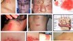 SHINGLES (herpes zoster) - Shingles Symptoms - Shingles Treatment - Shingles Images