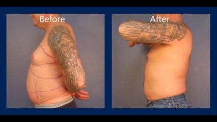 Smartlipo Laser Lipo on Male Patients by Silk Touch Medical Aesthetics