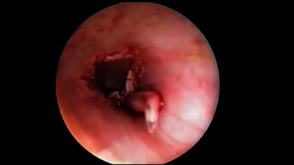 Doctors Discover MAGGOT in Woman's Ear (NSFL)