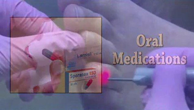 Laser Fungal Toenail Therapy - Podiatrist - Houston, TX - Britt Larka, DPM