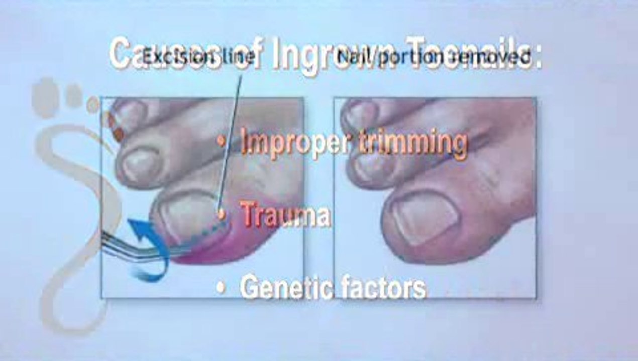 Houston, TX - Ingrown Toenail - Podiatrist Britt Larka, DPM