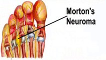 Houston, TX - Morton’s Neuroma - Podiatrist Britt Larka, DPM