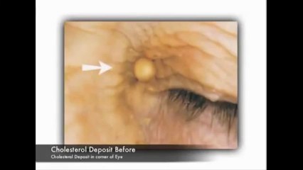 Skin Zone in Gold Coast - Minor Skin Irregularities Removal