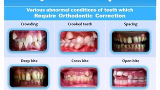 Information on Orthodontic Braces Video by Dr Bharat Agravat Ahmedabad India