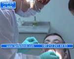 Tanfer Klinik - Diş eti kanamasını nasıl önleyebiliriz