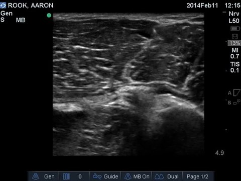 Ultrasound Guided Stem Cell Treatment | Pectoralis Tendon Injection 1