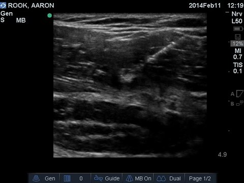 Ultrasound Guided Stem Cell Treatment | Pectoralis Muscle Injection 2