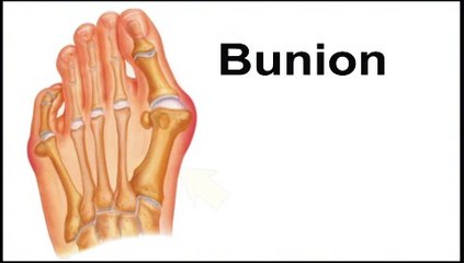 Richardson and Garland, TX -  Bunion Problem - Podiatrist Gene Reister, DPM