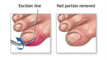 Richardson and Garland, TX -  Ingrown Nail - Gene Reister, DPM