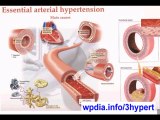 Hypertension - Hypertension Symptoms - Treating Hypertension