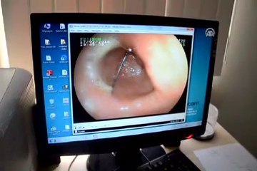 Yastık dikerken dikiş iğnesini yuttu