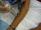 Como quitar los tatuajes con laser